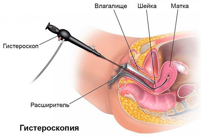 Как проводится гистероскопия