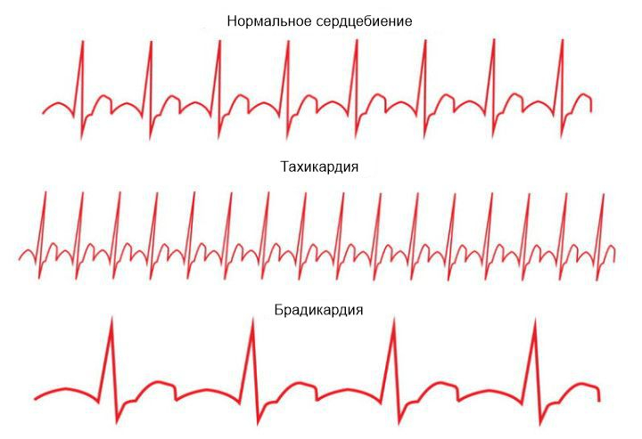 Виды тахикардии